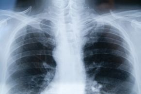 Mesothelioma Lung Cancer Lawsuits