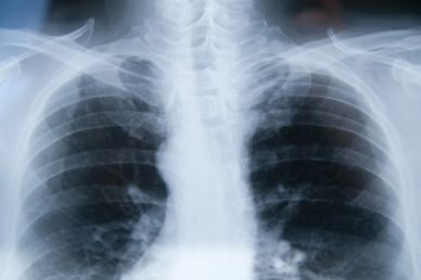 Asbestos Mesothelioma Lung Cancer Lawsuits