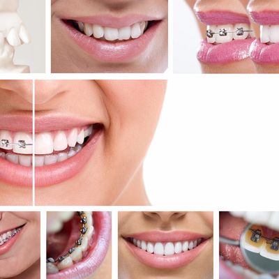 Invisalign vs Braces Cost Near Me in Dallas TX