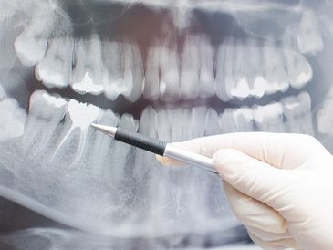 PANORAMIC DENTAL XRAY