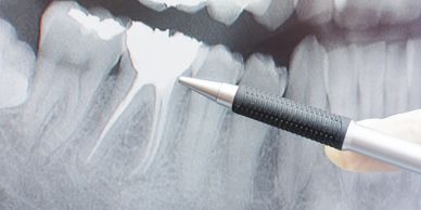 Radiografia panorâmica mostrando um dente com tratamento de canal executado.