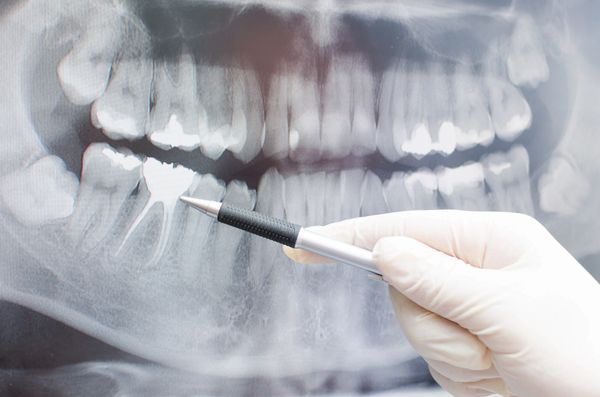 Dental X-ray showing teeth with a gloved hand pointing at a filling.