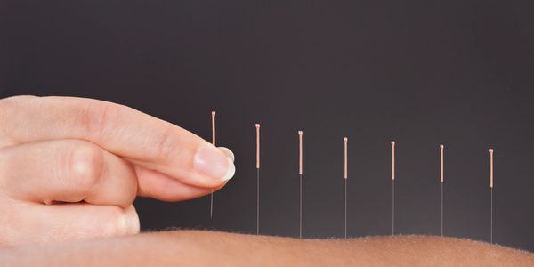A row of acupuncture needles being inserted on a patient
