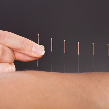 A series of acupuncture needle on a patient's skin