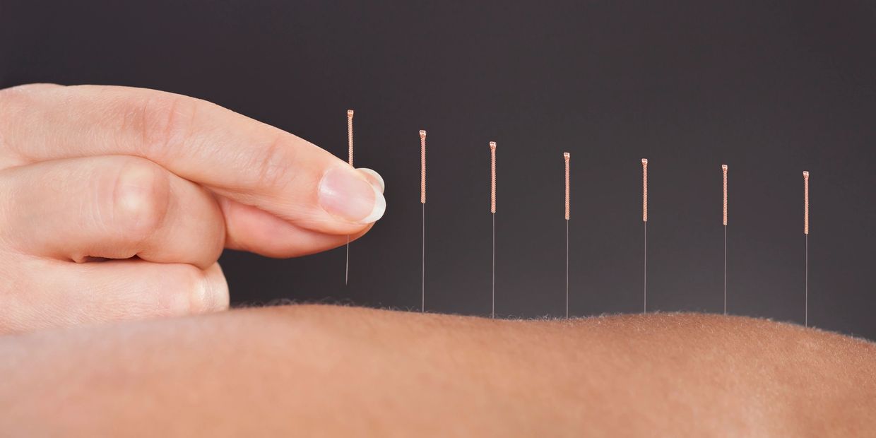 Acupuncture uses fine sterile one-time use needles to achieve pain relief and balance the meridians.