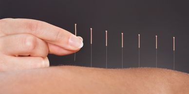 Acupuncture Chinese medicine medical acupuncture treatment pain relief muscle tightness relaxation