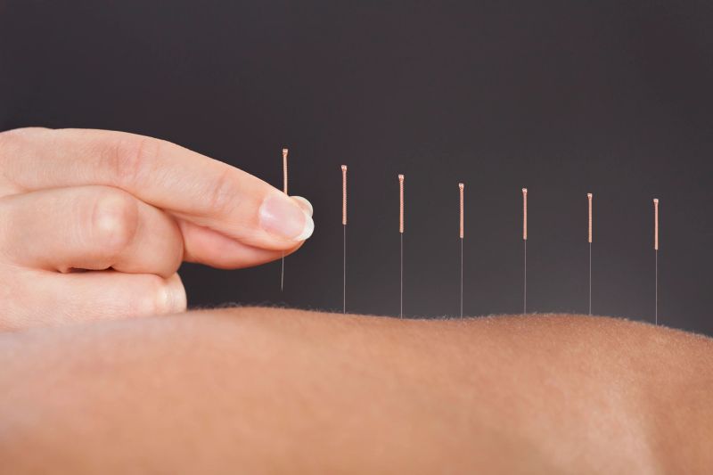 Acupuncture for back and joint pain
