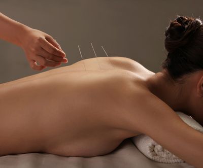A picture of a woman receiving acupuncture.