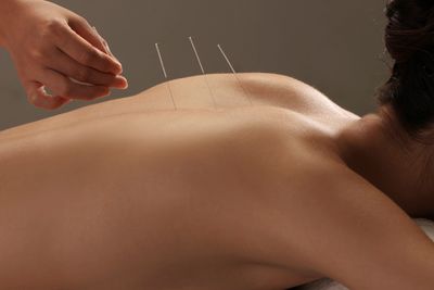 Back Pain and Acupuncture