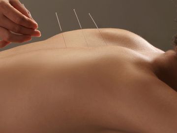 Physiotherapist in Brakpan - Dry Needling