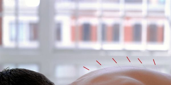 Acupuncture needles resting in a patient to treat back issues