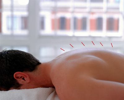 Acupuncture for back pain