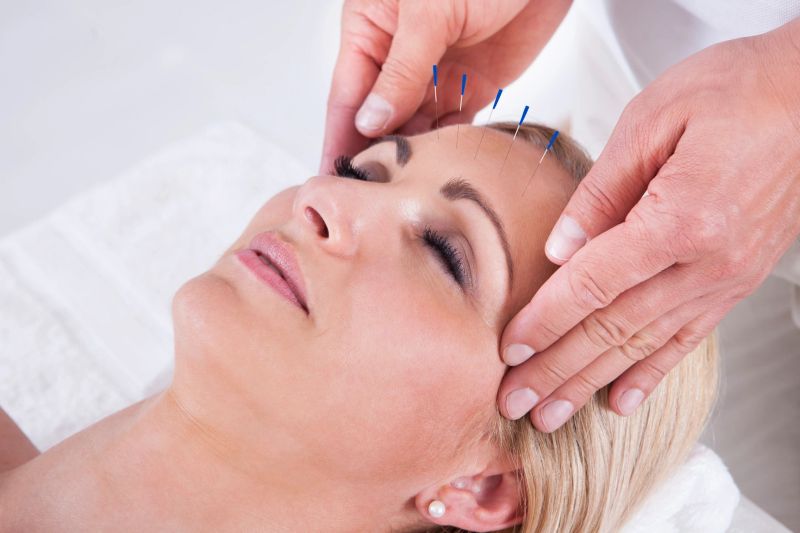 Acupuncture for headaches