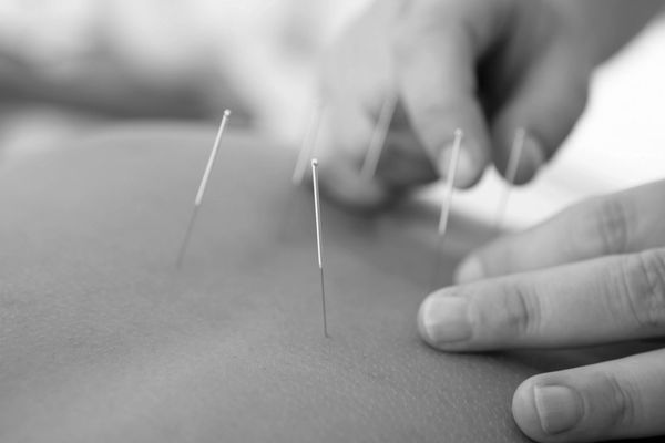 Acupuncture Practitioner applying needles