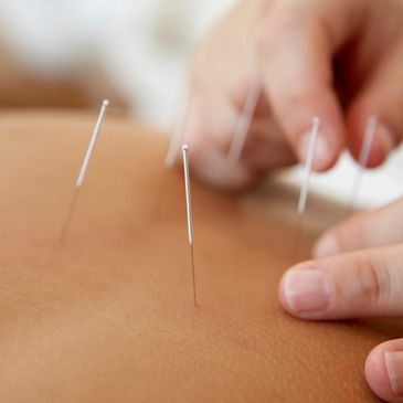 Dry needling Mooresville, NC