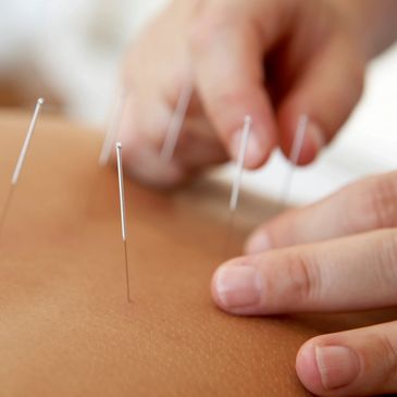 acupuncture needles, needles