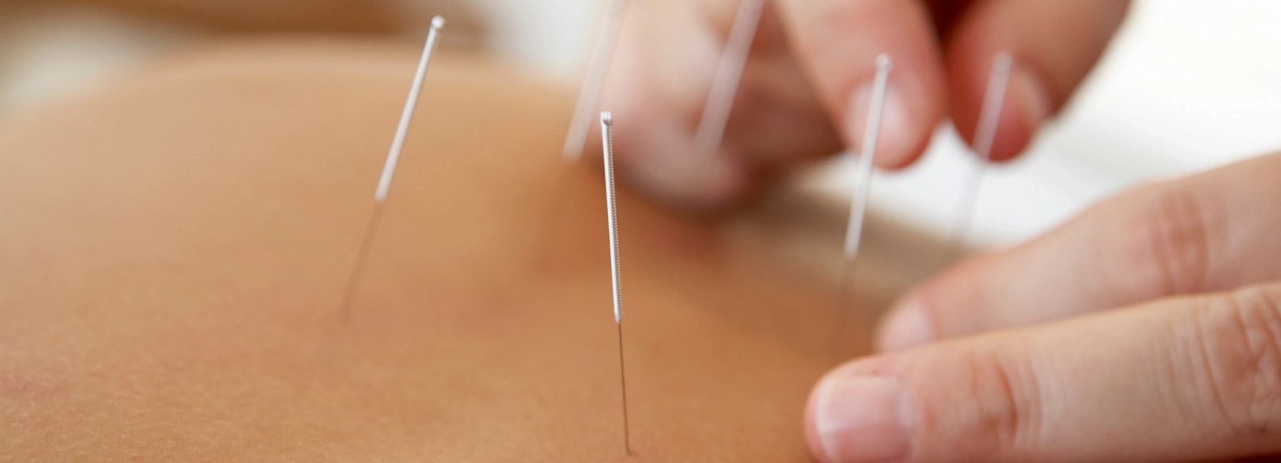 Acupuncture OCSI Clinic