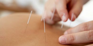 Acupuncture Therapy - Fine Needles Inserted Into Muscle For Stress Relief,Midhurst Barrie Ontario