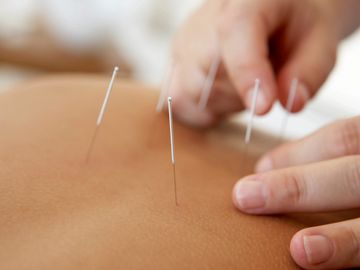 Acupuncture needles being inserted into a patient