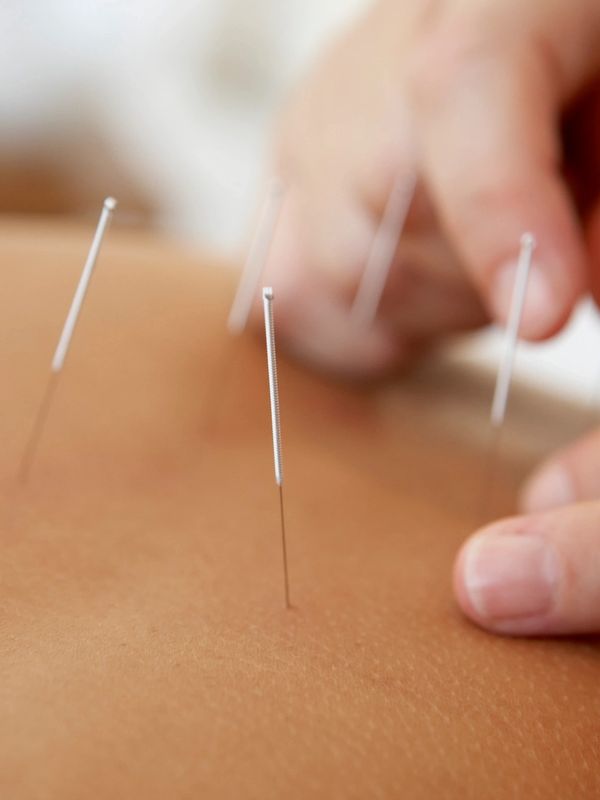 Close-up of acupuncture needles inserted in skin during treatment.