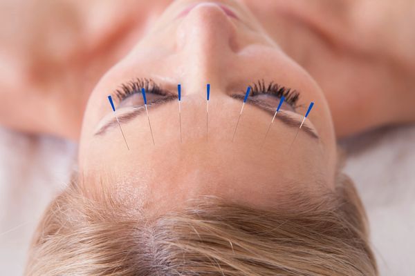 women receiving acupuncture cosmetic facial rejuvenation