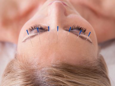 Cosmetic Acupuncture needles placed into forehead