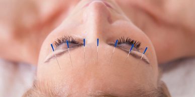 Facial cosmetic acupuncture provides non surgical facelifts 