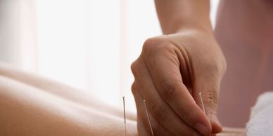 Acupuncture 