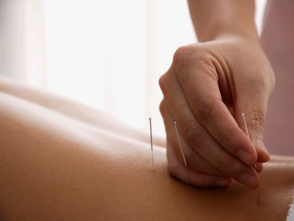 Hand inserting acupuncture needles into a person's back for therapy.
