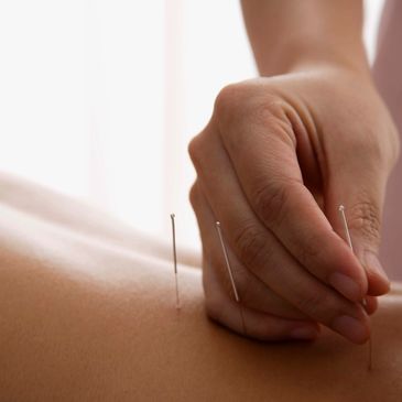 Acupuncture treatment