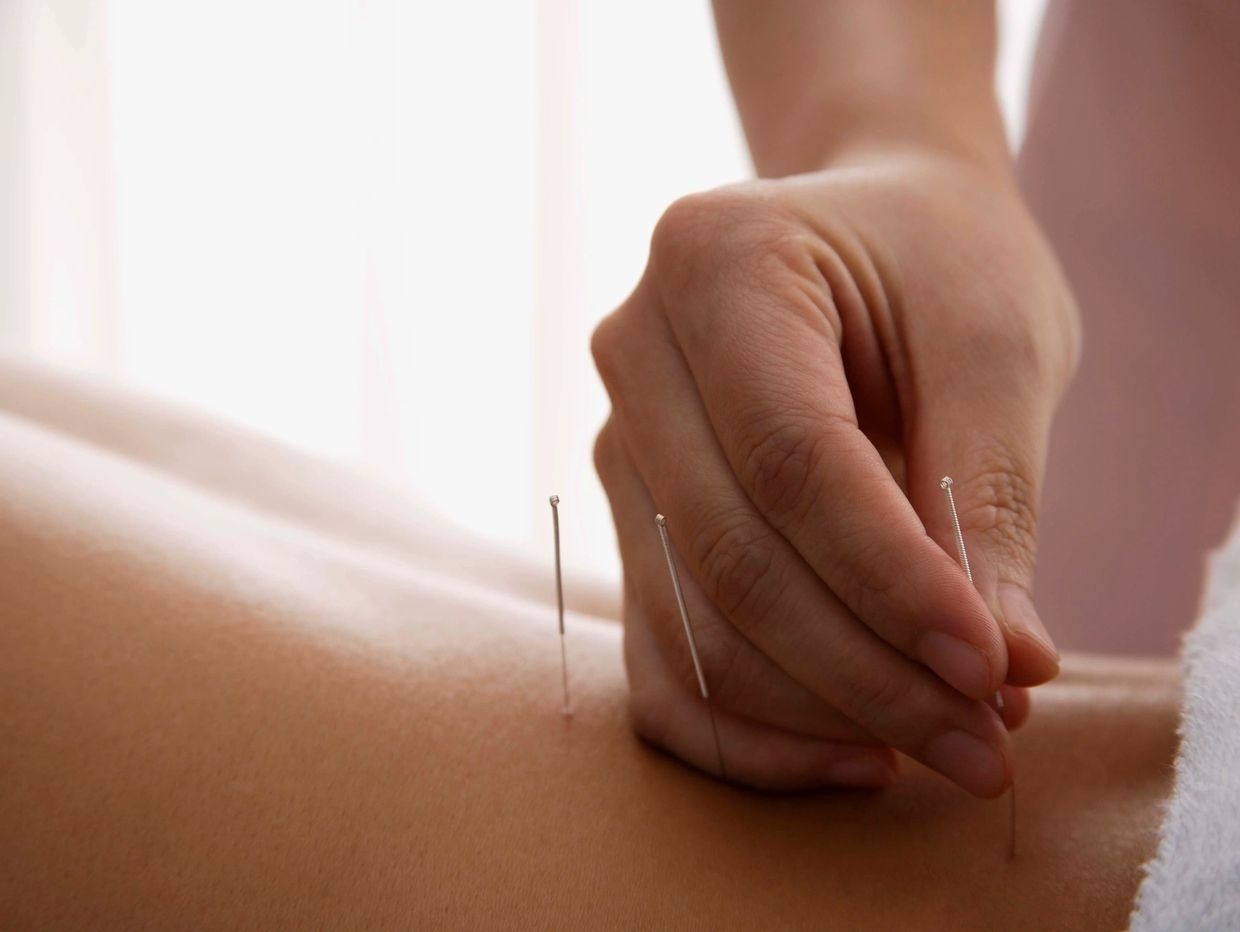 Close-up of acupuncture needles being inserted into skin.