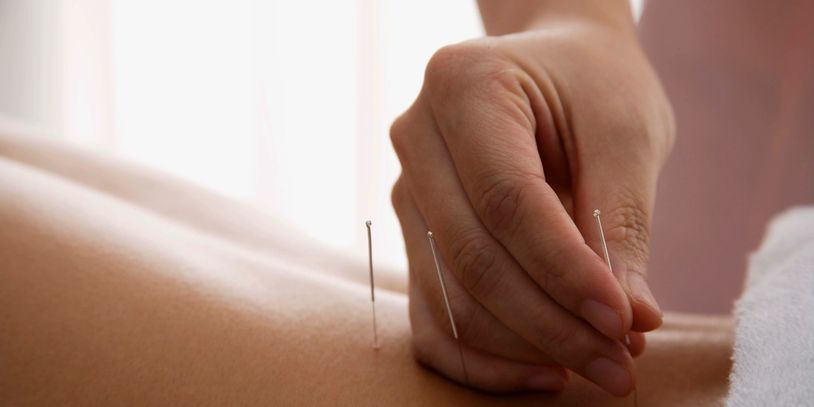 Close-up of acupuncture needles being inserted into skin.