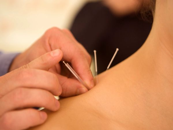 Hand receiving acupuncture treatment
