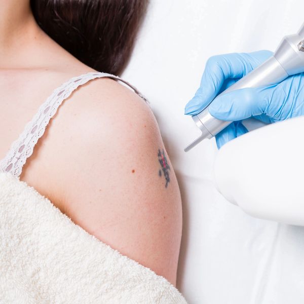 Laser tattoo removal in Mission, Calgary, AB