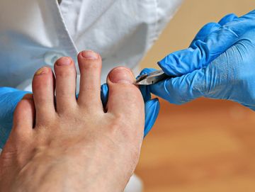 pedicure, unha encravada, calosidade, calos, prevenção, pes bonitos, unhas saudaveis, aveiro