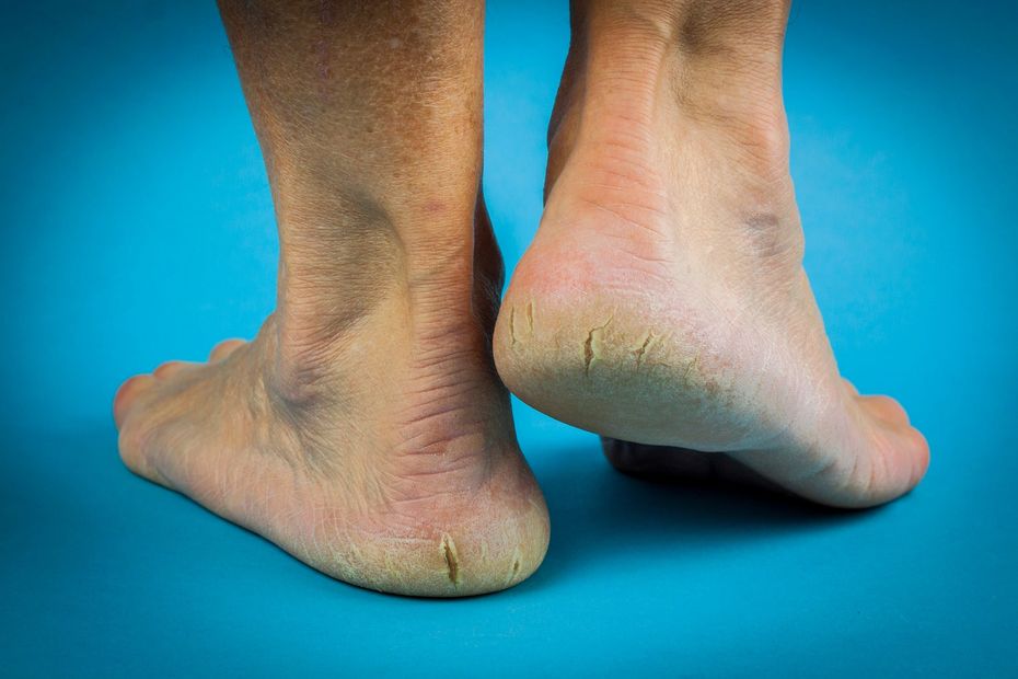 Cracked heels are a common foot problem treated by podiatrists.