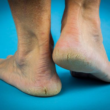 Foot Callus Removal: All You Need To Know - Northwich Foot Clinic