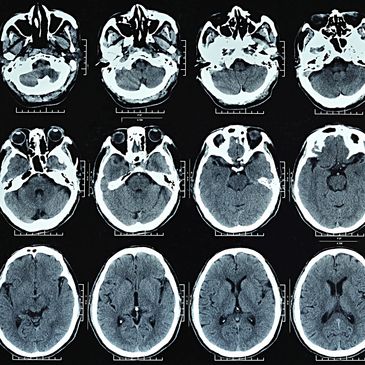 Multiple brain CT scan slices showing detailed brain structures.