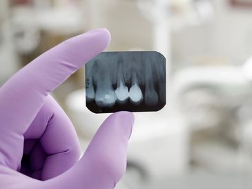 Implant placement: tooth replacement