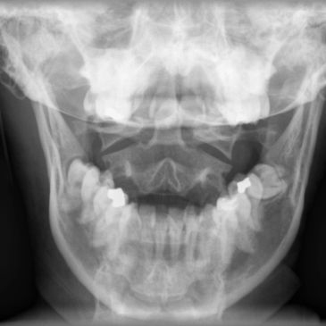 Dental X-ray showing teeth and jaw structure with fillings.