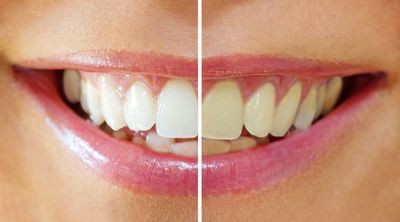 before & after teeth whitening