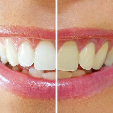 yellow and white teeth before and after teeth whitening