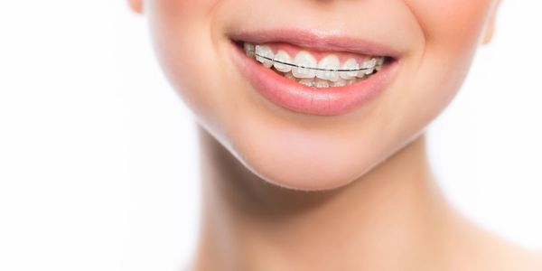 Close-up of a smiling person with clear braces on teeth.