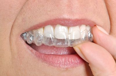 Invisalign Clear Braces