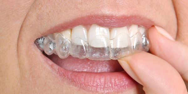 INVISALIGN | Green Oak Dental Center | Hamilton Dentist