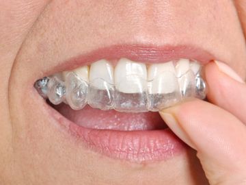 Richmond dentist, Dr. Galina, can help straighten crooked, crowded, or gapped teeth with aligners.