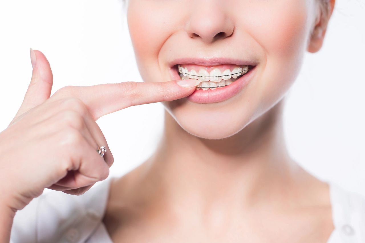 Invisalign Vs Ortodoncia Tradicional