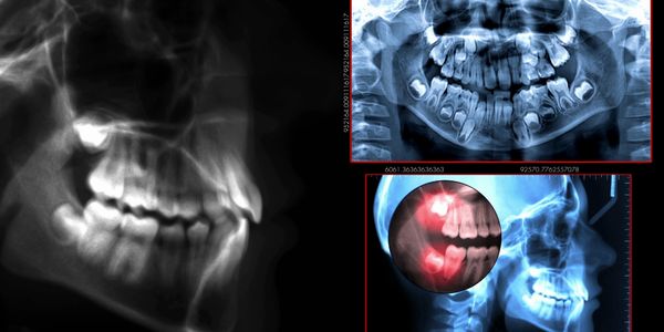 Xrays and Dentists consultation is free