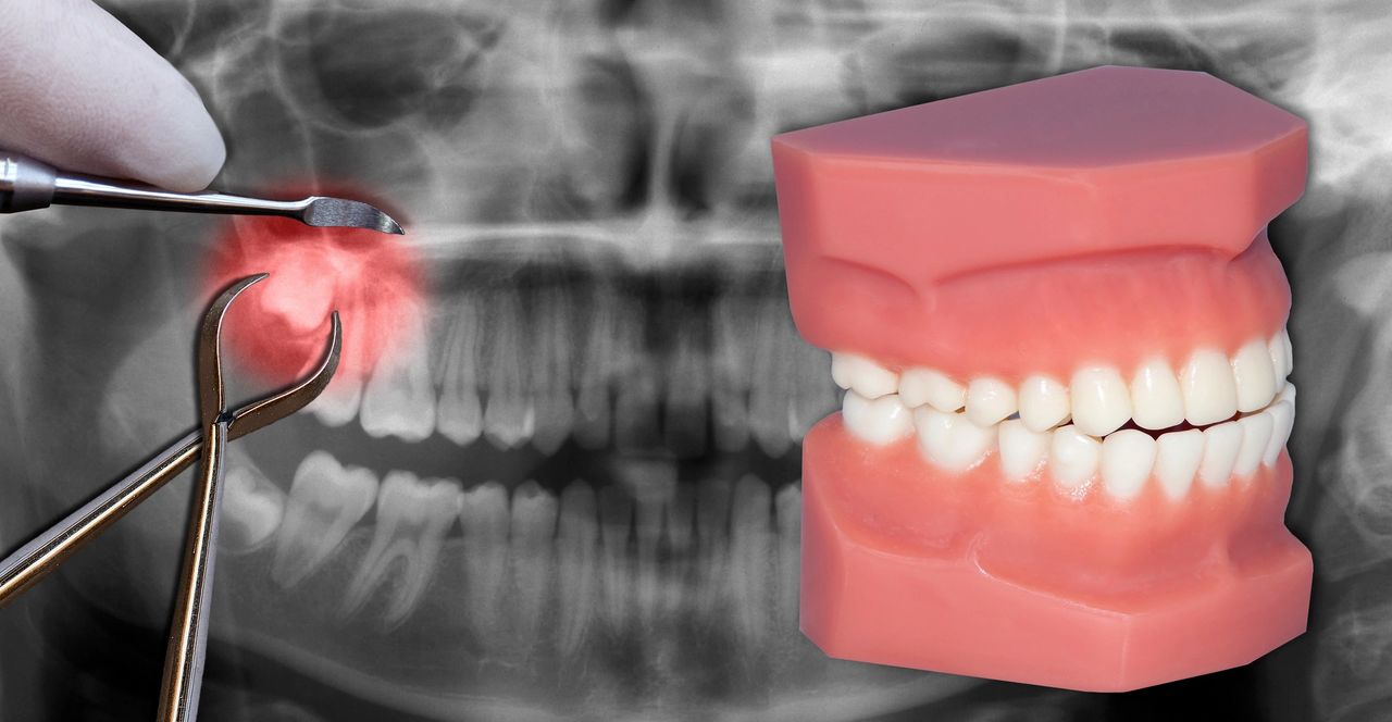 Gum Disease Natural Treatment