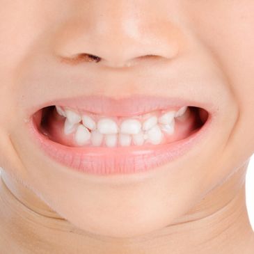 Close up of teeth on smiling young child. 